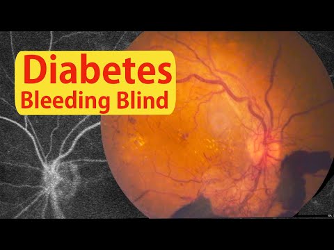 Bleeding in Your Eye: Diabetic Retinopathy (2023) - part 2-