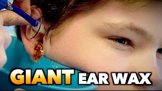 GIANT EAR WAX REMOVAL! | Dr. Paul