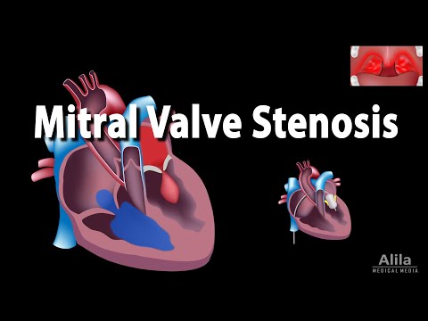 Mitral Valve Stenosis, Animation
