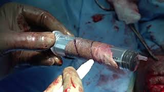 V04-01: Preputial Spiral Graft Urethroplasty for Panurethral Stricture