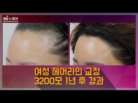 여성 헤어라인교정 1600모낭 3200모 Female Hairline Correction Surgery after 1year - 1600 grafts(뉴헤어)