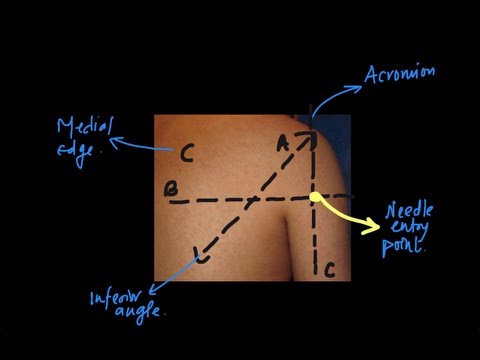 Shoulder block: Part 2 of 3