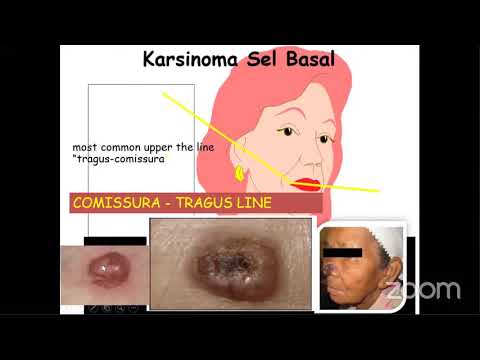 Webinar Medis: Penatalaksanaan Kanker Kulit
