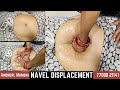 Navel Displacement Constipation Gas And Acidity Abdominal Pain And Swelling Get Fastest Relief