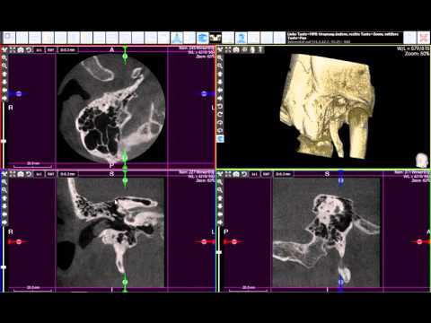DORNMEDICAL GmbH - X-Mind Trium HNO Felsenbein