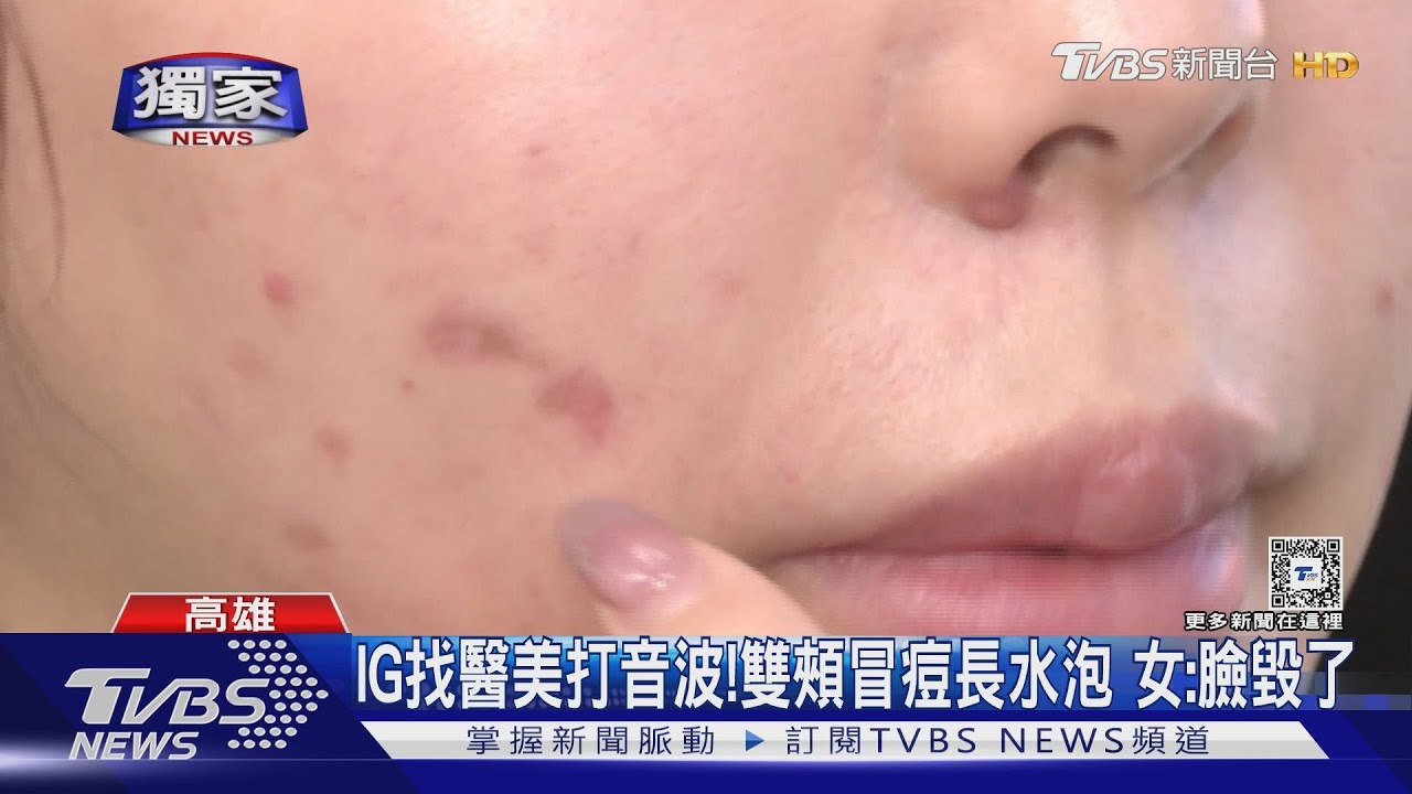 IG找醫美打音波！　雙頰長水泡女慘變大花臉