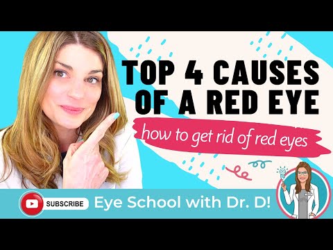 How To Get Rid Of Red Eyes | Top 4 Causes Of A Red Eye | An Optometrist Dishes all the Dirt!
