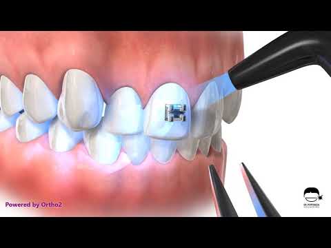 Einsetzen der festen Zahnspange mit Versiegelung