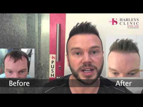 Harleys Hair Transplant Clinic In Mumbai- Hair Transplant Review
