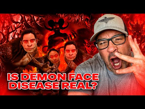 David Nino Rodriguez Live: Real?! Demon Face Syndrome Revealed