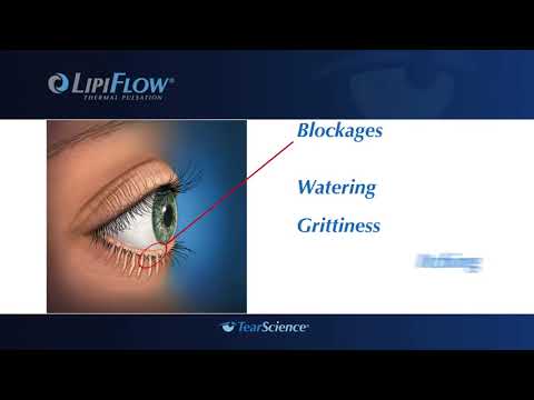 TearScience LipiFlow Dry Eye Treatment 1