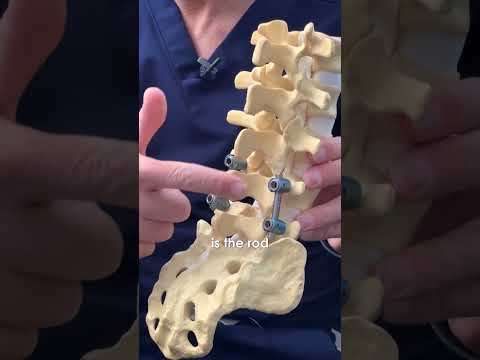 Know more about Pedicle Screws