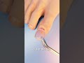 How Toenail Removal Works 😳