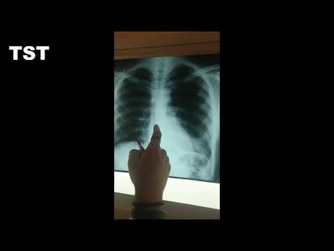 Arka Ön Göğüs Radyografisi   PA Akciğer Radyografisi