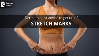 Tips to get rid of stretch marks on body due to extreme weight change-Dr.Rasya Dixit|Doctors