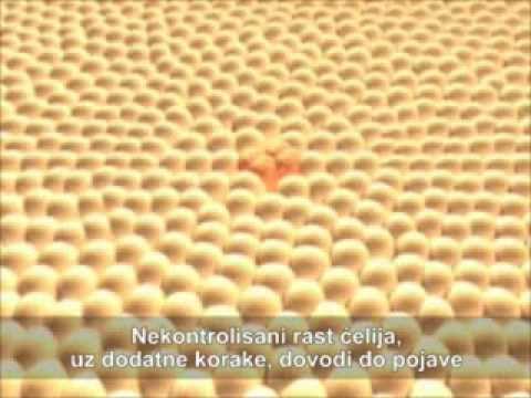 Simptomi i rano otkrivanje karcinoma debelog creva