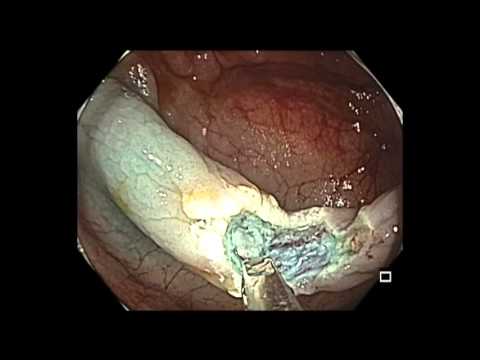 Colonoscopy: Ascending Colon Polyp Resection