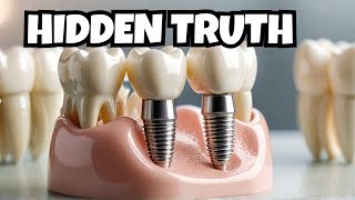 Dental Implants: What they don't tell you!