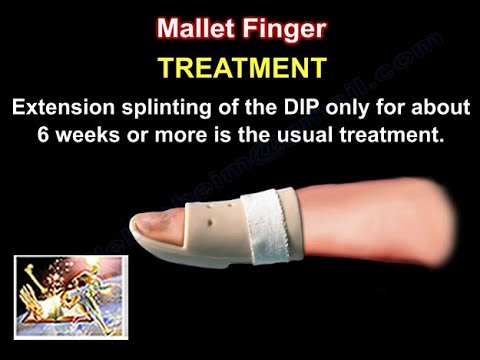 Mallet Finger Treatment - Everything You Need To Know - Dr. Nabil Ebraheim