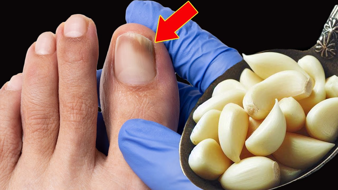 This is a nail fungus killer (It works very fast)