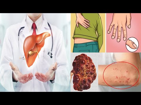 Nëse i keni këto 7 shenja në trup, kini kujdes pasi mëlçia juaj po vuan nga kjo sëmundje