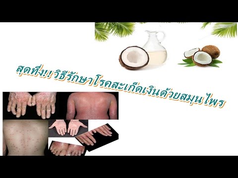 เป็นกลากเกิดขึ้น ไขมันแพะจากโรคสะเก็ดเงิน