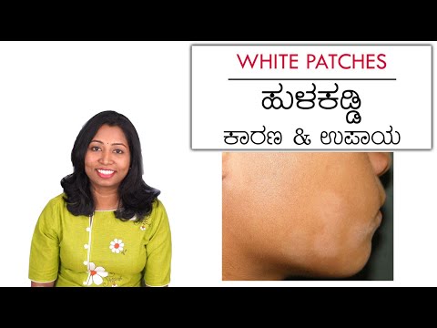 ಹುಳಕಡ್ಡಿ ಅಥವಾ ಬಿಳಿಯ ಚರ್ಮ ಮಕ್ಕಳಲ್ಲಿ ಏಕೆ ಬರುತ್ತದೆ? White Patches in Kids