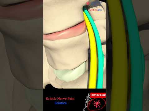 Sciatic nerve pain - Sciatica pathophysiology, causes and treatment