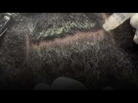 Jet Peel for Scalp Dermatitis