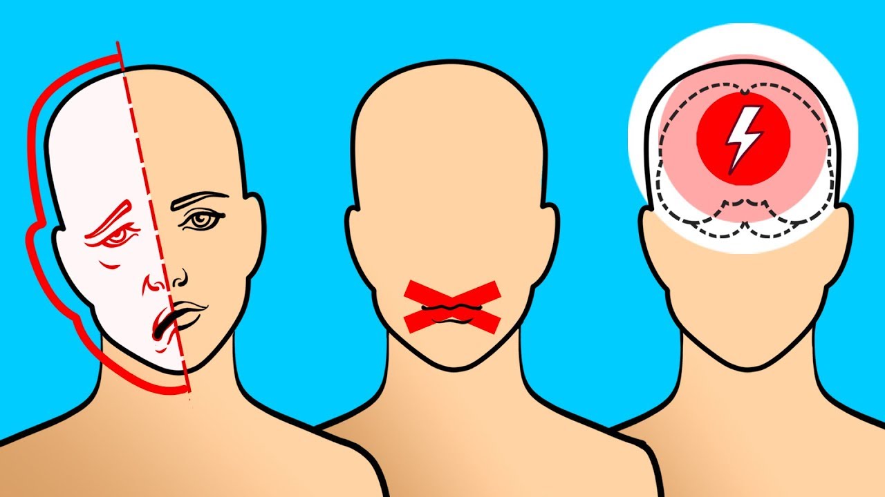 6 Señales que advierten sobre la proximidad de un derrame cerebral