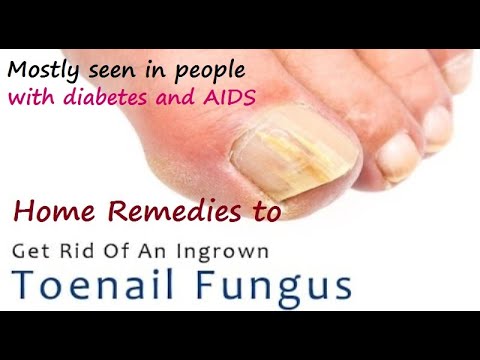 Kung clotrimazole lunas paa halamang-singaw Ano ang mga sintomas ng sakit kapag ang mga kuko halamang-singaw