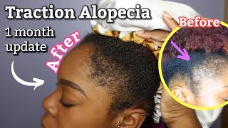 HOW I GREW MY EDGES IN 1 MONTH - Traction Alopecia