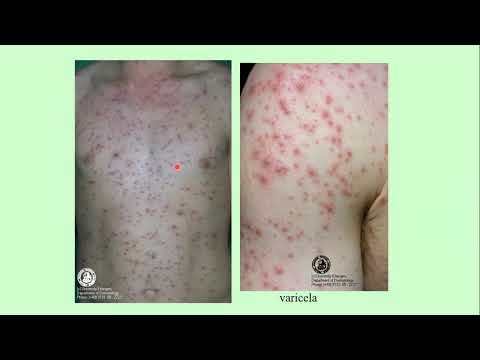 MICROBIOLOGIA BUCAL- Doenças virais de interesse na Odontologia