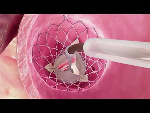 Evolut® Procedure for Aortic Stenosis Heart Valve Condition