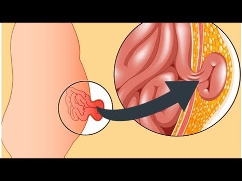 Rehabilitación de la articulación de la muñeca después de la fractura de vídeo Ejercicios de vídeo gratuito para la columna cervical