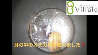 耳掃除動画vol.50「耳の中のカサカサが取れました」