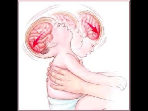 Shaken Baby Syndrome