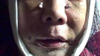 My Complete Facial Plastics Rejuvenation Video Blog & Diary 07