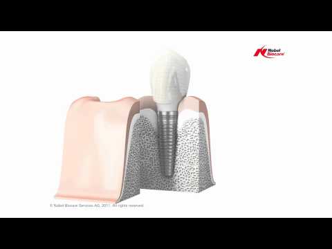 download lagu mp3 mp4 Dental Implant Singapore Medisave, download lagu Dental Implant Singapore Medisave gratis, unduh video klip Dental Implant Singapore Medisave