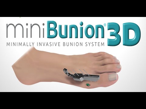 miniBunion 3D™ - MIS Bunion System with Viking™ Instrumentation