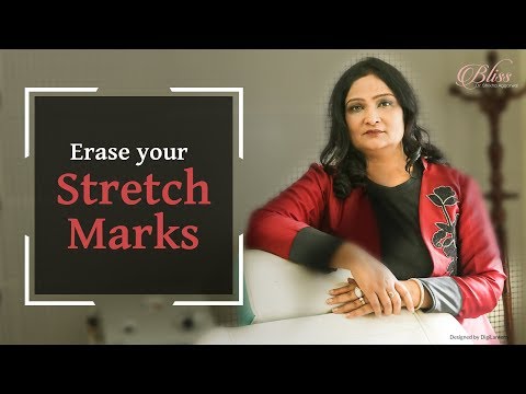 ResurFX Laser for Stretch Marks
