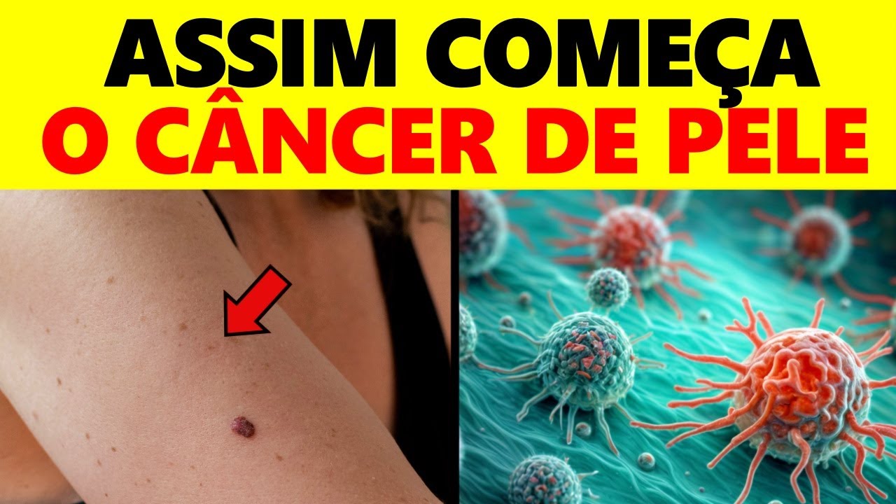 ALERTA! 10 Sinais de Câncer de Pele que Podem Aparecer da Noite para o Dia