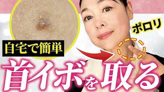 【完全解説】自宅でできる首イボ対策について美容のプロが解説！！