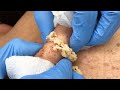 Stubborn Sac and Cyst Removal | CONTOUR DERMATOLOGY