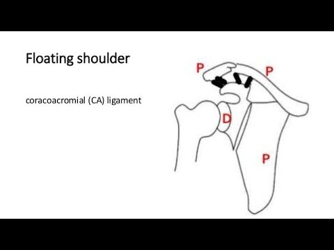 Discuss Floating shoulder; a clinical application of shoulder joint anatomy