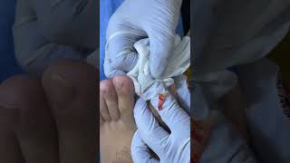 Ep_8296 Ingrown toenail removal 👣 ไม่ต้องอธิบาย..ดูเล็บหนู 😄 (clip from Thailand)
