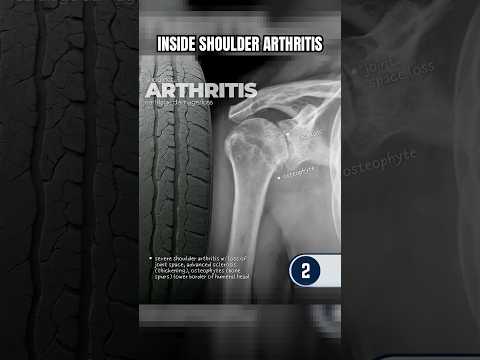 Inside Look At Devastating Shoulder Arthritis Damage⁉️