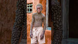 14-Year- Old Boy’s Skin Turn Into Stone: BORN DIFFERENT