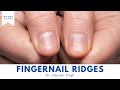 Do You Have Vertical Ridges On Your Fingernails? Here's What They Mean!