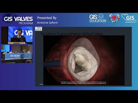 26  Antoine lafont   TMVI Using Novel Percutaneous Valves Tendyne